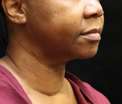 Scarless Facelift and Necklift Before & After Patient #11104