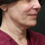 Scarless Facelift and Necklift Before & After Patient #11105