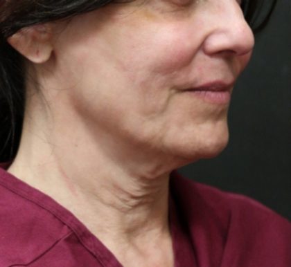Scarless Facelift and Necklift Before & After Patient #11105