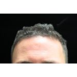Hair Restoration Before & After Patient #11146