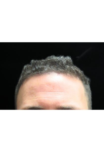 Hair Restoration Before & After Patient #11146
