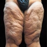 Thigh Lift Before & After Patient #10845