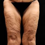 Thigh Lift Before & After Patient #10846