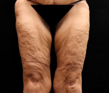 Thigh Lift Before & After Patient #10846