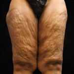 Thigh Lift Before & After Patient #10847