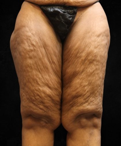 Thigh Lift Before & After Patient #10847