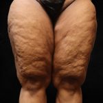 Thigh Lift Before & After Patient #10848