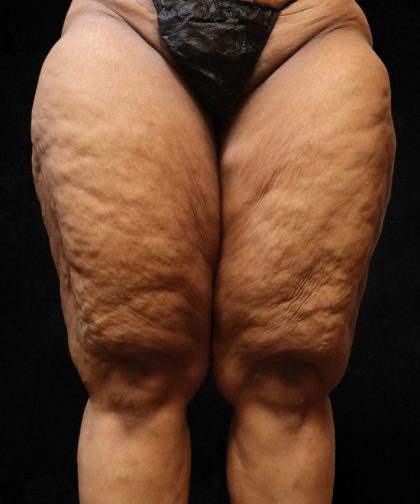 Thigh Lift Before & After Patient #10848