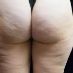 Cellulite Treatment Before & After Patient #10860