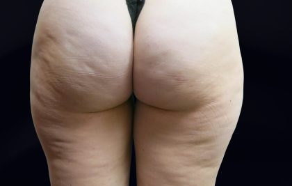 Cellulite Treatment Before & After Patient #10860