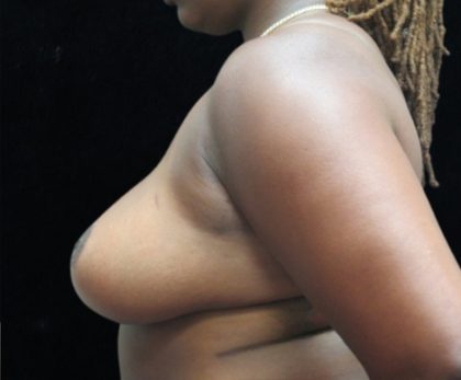 Breast Asymmetry Before & After Patient #10905