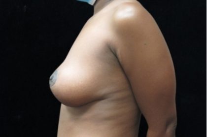 Breast Lift Before & After Patient #11044