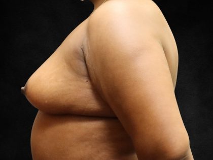 Breast Lift Before & After Patient #11049