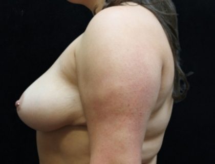 Breast Asymmetry Before & After Patient #10895