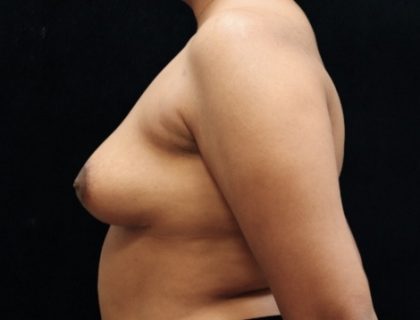 Breast Asymmetry Before & After Patient #10901