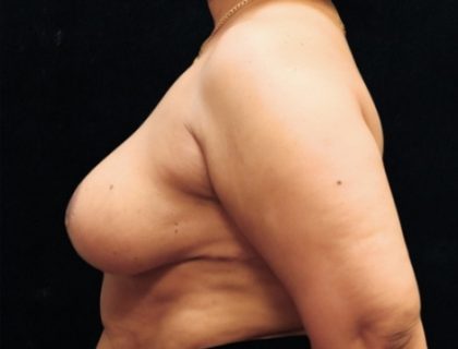 Breast Asymmetry Before & After Patient #10903