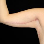 Arm Lift Before & After Patient #10812