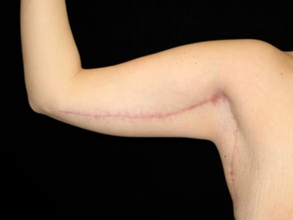 Arm Lift Before & After Patient #10812