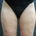 Cellulite Treatment Before & After Patient #10861