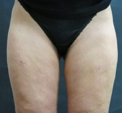 Cellulite Treatment Before & After Patient #10861