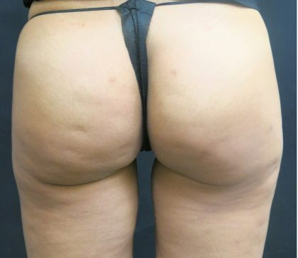 Cellulite Treatment Before & After Patient #10862