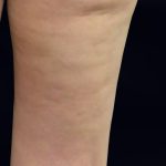 Cellulite Treatment Before & After Patient #10863