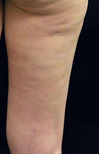 Cellulite Treatment Before & After Patient #10863