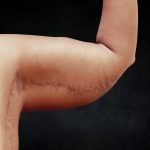 Arm Lift Before & After Patient #10814