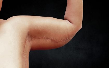 Arm Lift Before & After Patient #10814