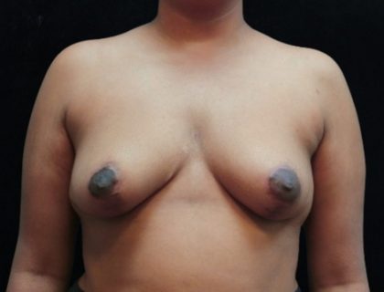 Breast Asymmetry Before & After Patient #10901