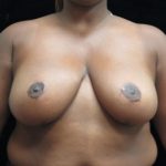 Breast Asymmetry Before & After Patient #10905