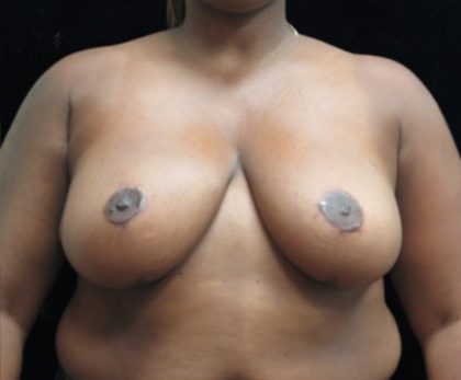 Breast Asymmetry Before & After Patient #10905