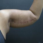 Arm Lift Before & After Patient #10813