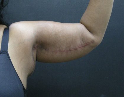 Arm Lift Before & After Patient #10813