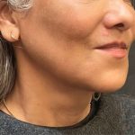 Scarless Facelift and Necklift Before & After Patient #11100