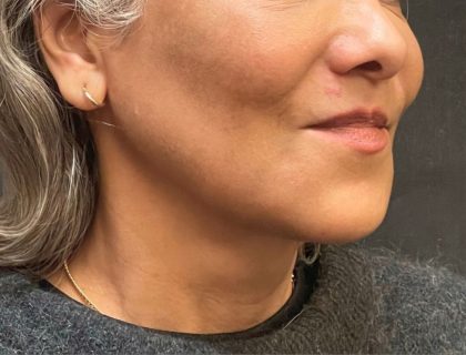 Scarless Facelift and Necklift Before & After Patient #11100