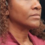 Scarless Facelift and Necklift Before & After Patient #11101