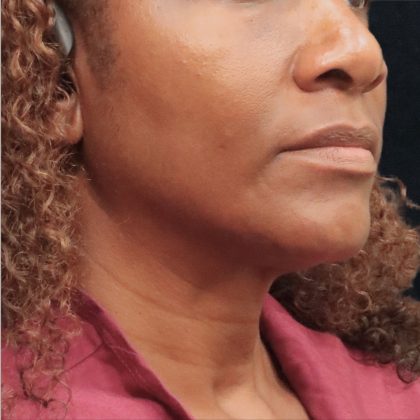 Scarless Facelift and Necklift Before & After Patient #11101