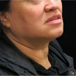 Scarless Facelift and Necklift Before & After Patient #11102