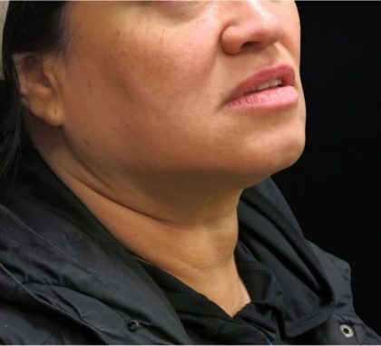 Scarless Facelift and Necklift Before & After Patient #11102