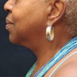 Scarless Facelift and Necklift Before & After Patient #11103