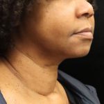 Scarless Facelift and Necklift Before & After Patient #11104
