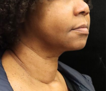 Scarless Facelift and Necklift Before & After Patient #11104