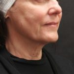 Scarless Facelift and Necklift Before & After Patient #11105