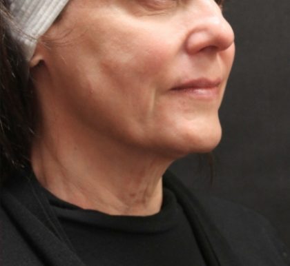 Scarless Facelift and Necklift Before & After Patient #11105