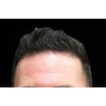 Hair Restoration Before & After Patient #11146