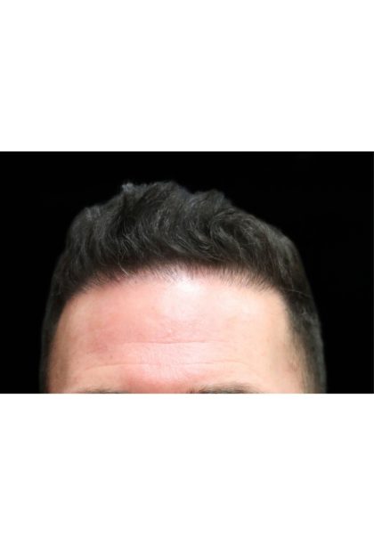 Hair Restoration Before & After Patient #11146