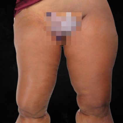 Thigh Lift Before & After Patient #10845