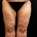 Thigh Lift Before & After Patient #10846