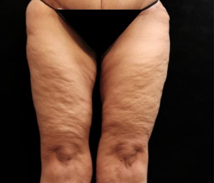 Thigh Lift Before & After Patient #10846